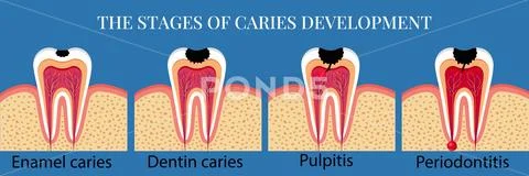Stages of caries development. Ilustraciones de archivo