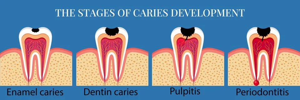 Stages of caries development. Stock Illustration