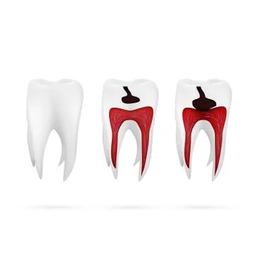 Stages Of Caries Development Isolated On White Stock Illustration