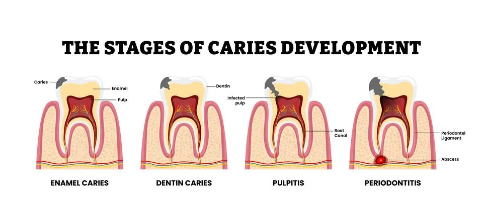 Stages of caries development stages. Labeled enamel, dentin caries, pulpiti.. Stock Illustration
