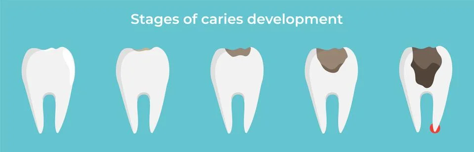 Stages of caries development, tooth dekay, dental concept, vector illustration. Stock Illustration