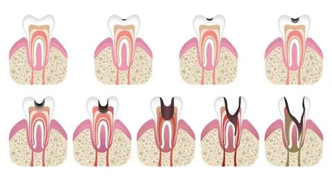 Stages of caries development. Tooth structure in flat style. Tooth decay with Illustrazione stock