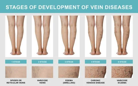 Stages of development of vein diseases. Photos of woman and zoomed skin are.. Stock Photos