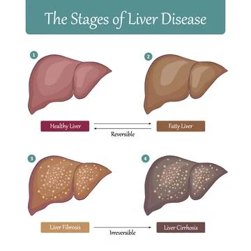 Stages of Liver Damage flat vector illustration. Stock Illustration
