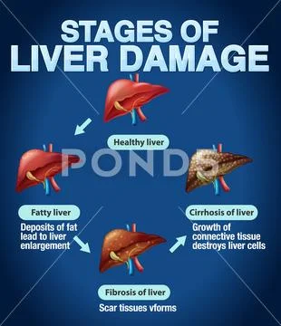 Stages of Liver Damage Infographic: Royalty Free #237417042