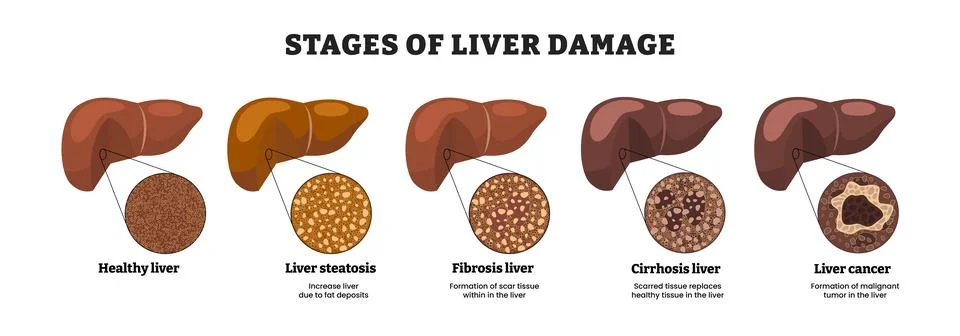Stages of liver damage stages progress, educational medical poster design h.. Illustrazione stock