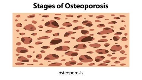 Stages of osteoporosis showing normal bone osteopenia osteoporosis and seve.. Stock Footage 333839860