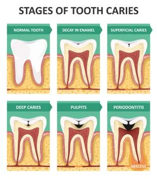 Stages of tooth caries Stock Illustration