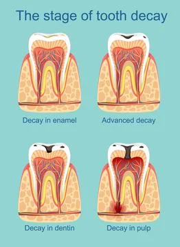 Stages of Tooth Decay Illustration Stock Illustration