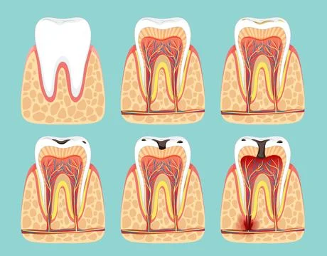 Stages of Tooth Decay Illustration Stock Illustration