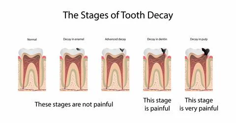 The stages of tooth decay, Tooth decay is damage that occurs to teeth Stock Illustration