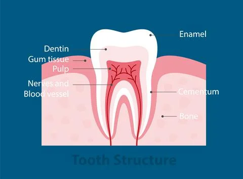 The stages of tooth decay, vector illustration Illustrazione stock