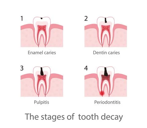 The stages of tooth decay, vector illustration Stock Illustration