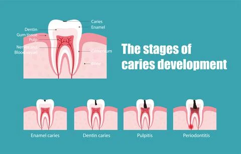 The stages of tooth decay, vector illustration Illustrazione stock
