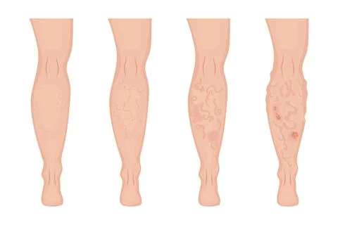 Stages of varicose veins developing on human leg Stockillustratie