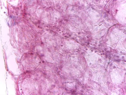 Stained Micrograph of Compact Pseudoepithelial/Epithelioid Cellular Layer C.. 스톡 사진