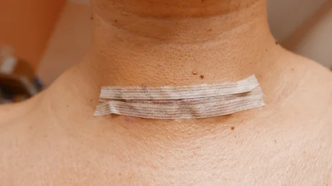 Static close up of thyroid operation scar of a man with adhesive bandage. Stock Footage 126258609