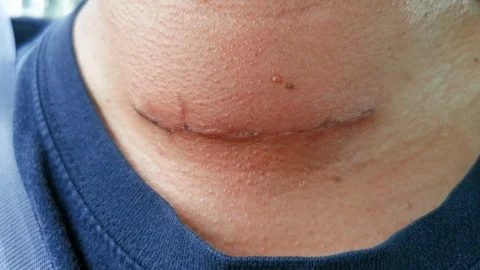 Static close up of thyroid operation scar of a man. Stock Footage 126504093