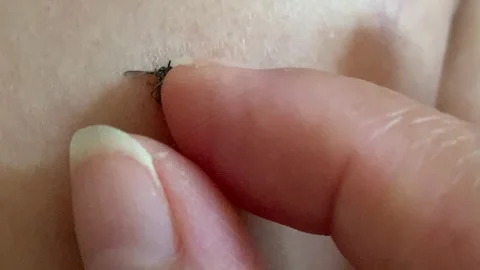 Static Closeup Macro Index Finger Checking Swatted Mosquito on The Skin 4K 스톡 동영상 343067554