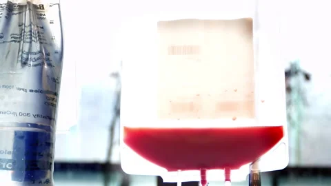 Stem Cell Donation Process on Apheresis Machine in Hospital (bag of stem cells) Stock Footage 316221670