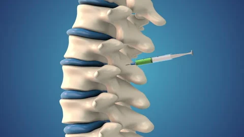 Stem cell injecting into a human spine Stock Footage 252189411