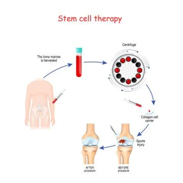 Stem cell therapy. Before and after of Sports injury. Stock Illustration