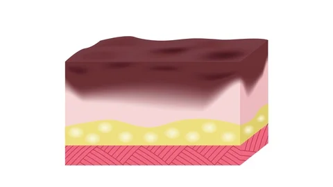 Step of burn . Normal to serious burn skin graphic animation 스톡 동영상 85969827