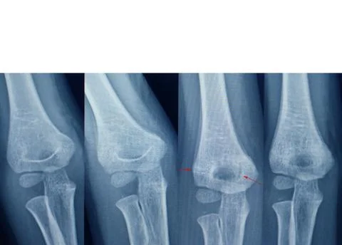 Step elbow fracture First time, two weeks, one month and two months Stock Photos