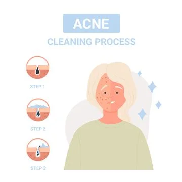 Steps for cleaning process against skin acne Stock Illustration