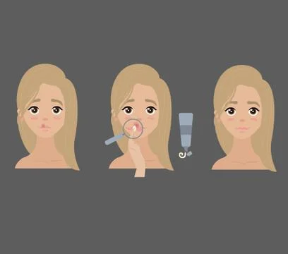 Steps how to apply anti herpes lip cream Stock Illustration