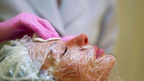 A sterile needle is inserted at an angle into the skin near the eye, a cosmetolo Stock Footage 288613937