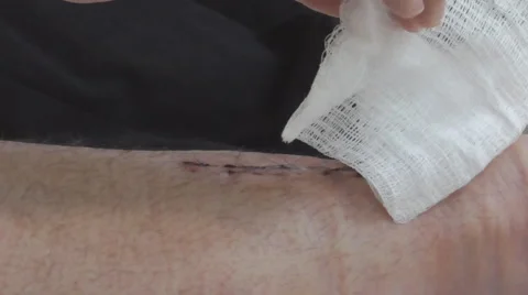 Stiches after surgery Stock-Footage 56194437