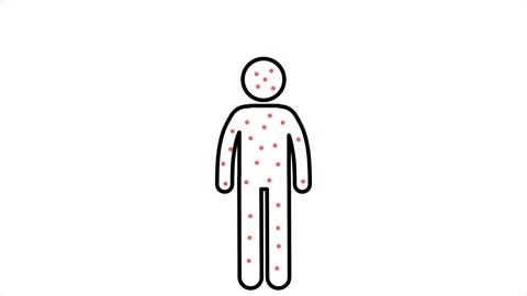 Stick figure man suffering from chickenpox infection illustration Stock Footage 318564748