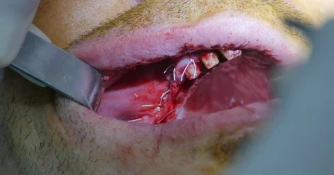 Stitch jaw surgery Video stock 70172441