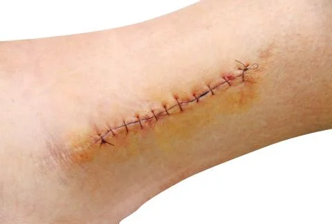 Stitches in the leg (ankle) Stock Photos
