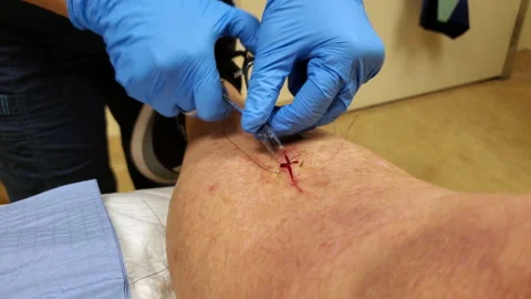 Stitches in leg 스톡 동영상 168023318