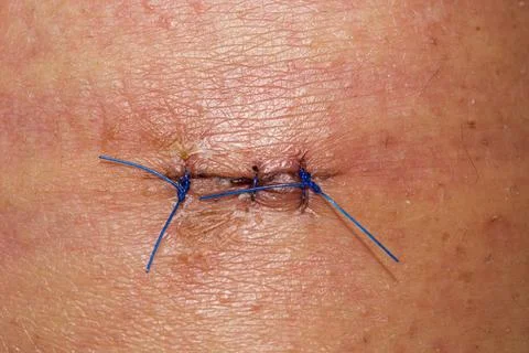 Stitches Ready To Be Removed Stock Photos