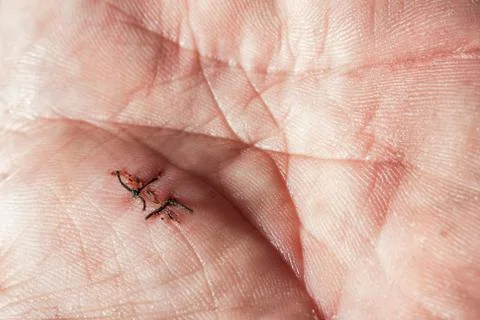 Stitches in wounded hand Stock Photos