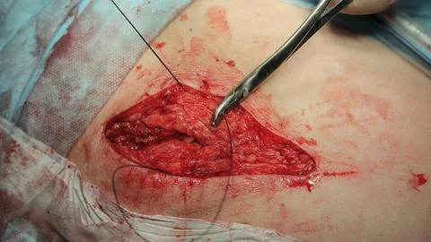 Stitching After Surgery CU Foto stock