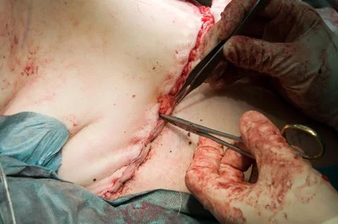 Stitching a wound Stock Photos