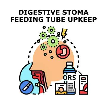 Stoma feeding tube upkeep solution concept Stock Illustration