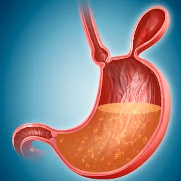 Stomach with hernia, illustration Stock Illustration