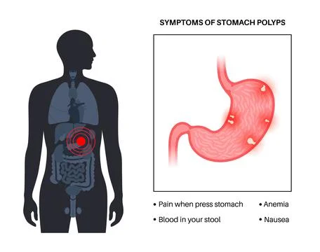 Stomach polyp disease Stock Illustration