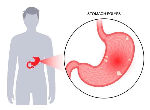 Stomach polyp disease Stock Illustration