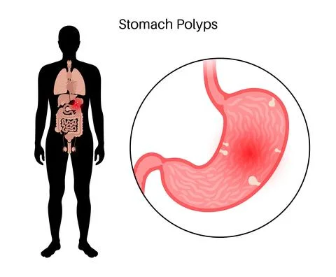 Stomach polyp disease Stock Illustration