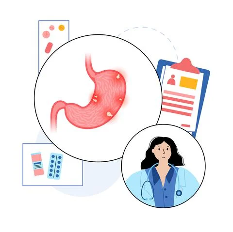 Stomach polyp disease Stock Illustration
