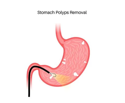 Stomach polyp removal Stock Illustration