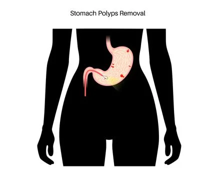 Stomach polyp removal Stock Illustration