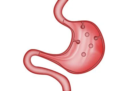Stomach polyps of the digestive system Stock Illustration