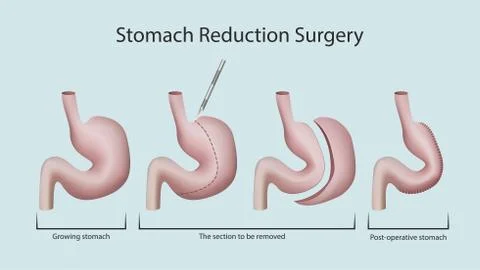 Stomach reduction surgery Stock Illustration